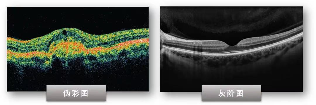 optical coherence tomography