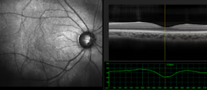 Detección temprana de la retinopatía diabética mediante imágenes OCT