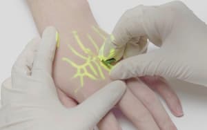 Alivio de la fobia a las agujas: ¿Cómo ayuda la tecnología Vein Finder a los pacientes ansiosos?