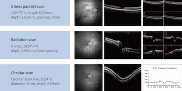 IA + OCT: ¿Cómo puede la inteligencia artificial ayudar a los oftalmólogos a diagnosticar con mayor rapidez y precisión?