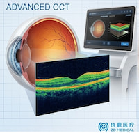 Cómo las plataformas de OCT de alta resolución de ZD Medical están revolucionando el diagnóstico oftálmico temprano