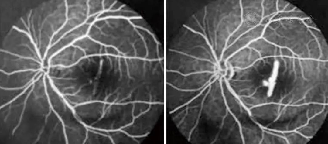 El papel de la OCT en el examen y tratamiento del fondo de ojo